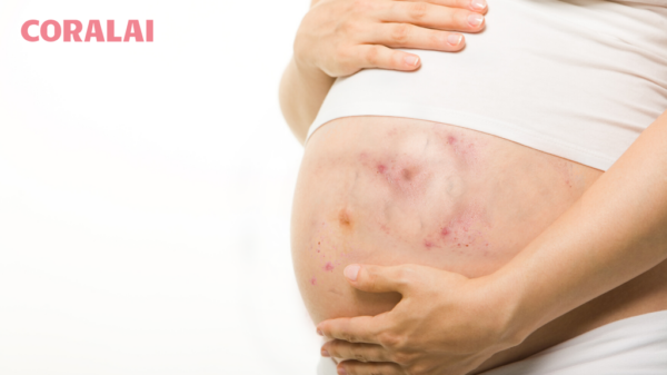 Pregnancy Rashes Symptoms Causes Treatment And Prevention